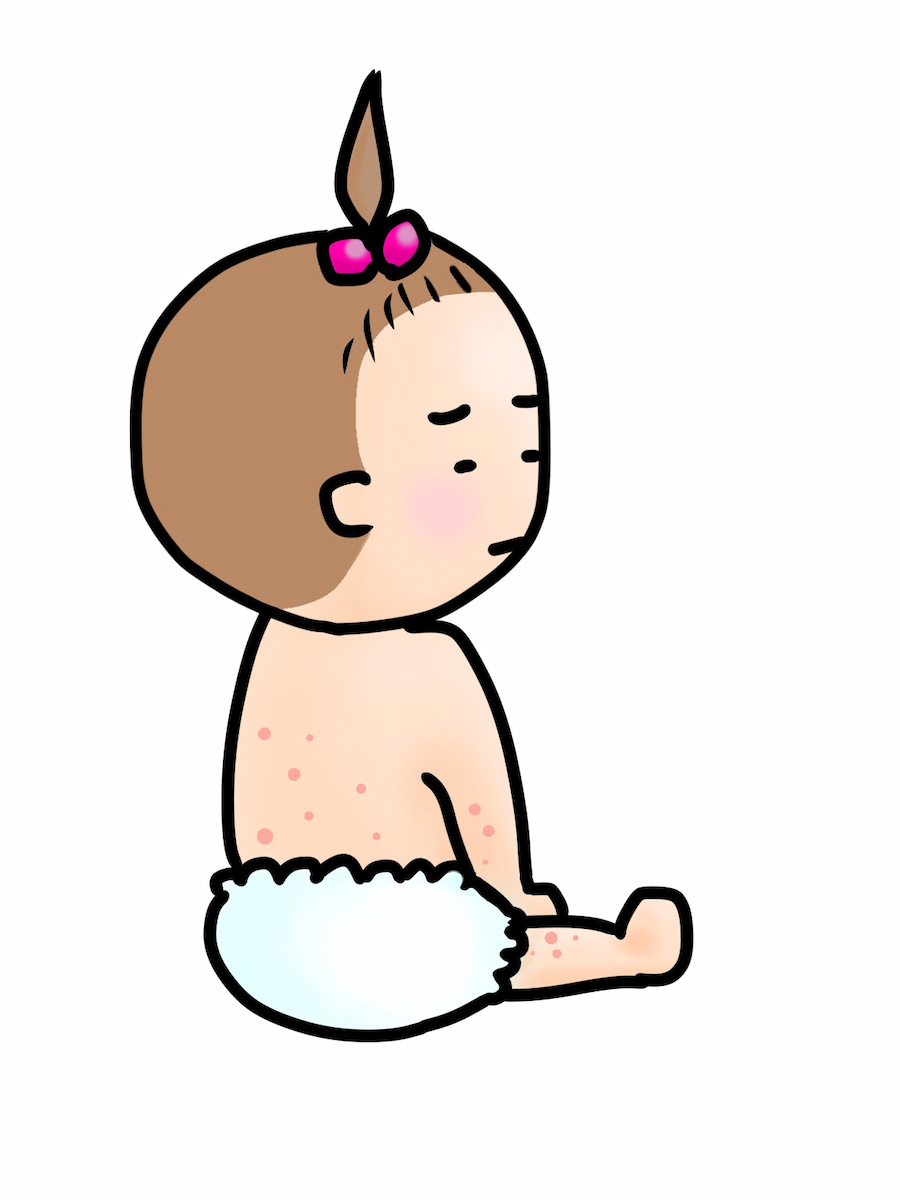 乳児湿疹